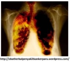 obat herbal penyakit kanker paru paru